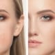 Uneven Skin Tone